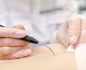 Electrocautery (Skin Tags Removal)